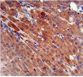 IHC testing of FFPE human hepatocarcinoma with Carboxylesterase 2 antibody. HIER: steam section in p