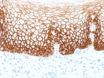 IHC testing of FFPE human cervical carcinoma with CD44v9 antibody (clone CD44v9/1459). Required HIER