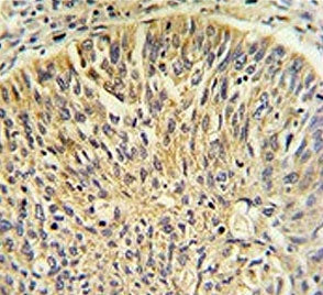 IHC testing of FFPE human lung carcinoma tissue with TCP1 gamma antibody. HIER: steam section in pH6