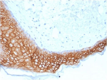 IHC testing of FFPE human basal cell carcinoma with TROP2 antibody (clone TACSTD2/2153). Required HI