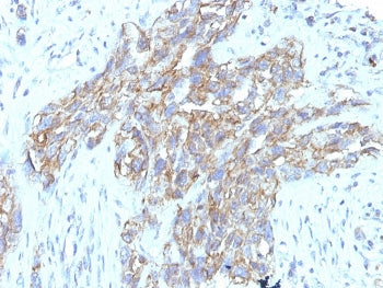 IHC staining of FFPE human lung carcinoma tissue with CD56 antibody (clone 123C3.D5 + 123A8). HIER: 