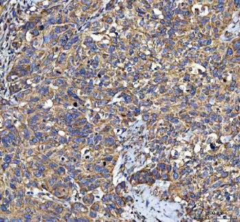 IHC staining of FFPE human bladder urothelial carcinoma tissue with LIN7C antibody. HIER: boil tissu