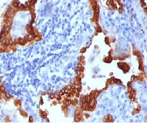 IHC testing of FFPE human lung carcinoma stained with Cytokeratin 8 antibody (clone CYKN8-1). Requir