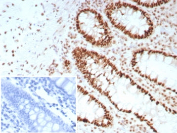 IHC staining of FFPE human colon carcinoma tissue with SATB2 antibody (clone SATB2/8697R). Inset: PB