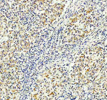 Immunohistochemical staining of FFPE human lymphoma tissue with MALT1 antibody, HRP-secondary and DA