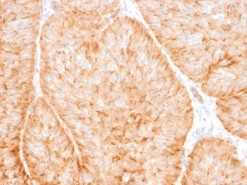 IHC testing of human bladder carcinoma with GLUT1 antibody (clone GLUT1/2475). Required HIER: boil t