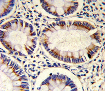 IHC testing of FFPE human colon carcinoma tissue with SORBS2 antibody. HIER: steam section in pH6 ci