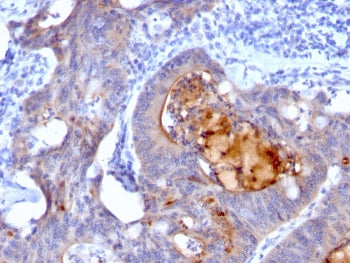 IHC: Formalin-fixed, paraffin-embedded human colon carcinoma stained with recombinant Secretory Comp