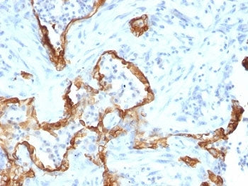 IHC: Formalin-fixed, paraffin-embedded human lung carcinoma stained with Cytokeratin 8 antibody (clo