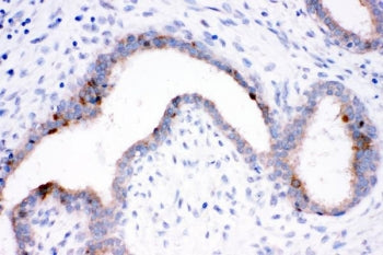 IHC staining of FFPE human breast cancer tissue with HSP70 antibody. HIER: boil tissue sections in p