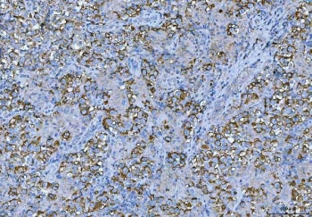 IHC staining of FFPE human testicular seminoma tissue with FMRP antibody. HIER: boil tissue sections