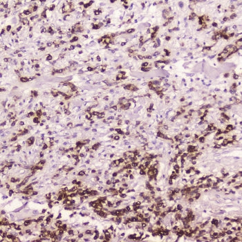 IHC testing of FFPE human gastric cancer with Cathepsin E antibody at 2ug/ml. HIER: boil tissue sect