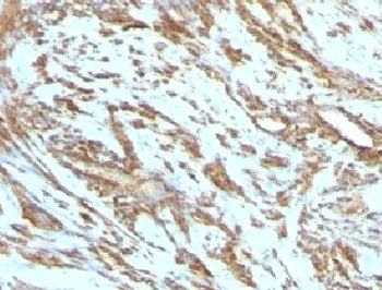 IHC testing of FFPE human leiomyosarcoma with Muscle Actin antibody. FFPE testing requires sections 