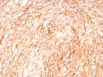 IHC staining of FFPE human GIST with CD117 antibody (clone C117/8879R) at 2ug/ml. HIER: boil tissue 