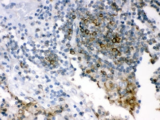 IHC testing of FFPE human lung cancer using SHC antibody. HIER: Boil the paraffin sections in pH 6, 