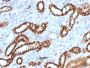 IHC testing of FFPE human renal cell carcinoma with recombinant Cadherin 16 antibody (clone rCDH16/1