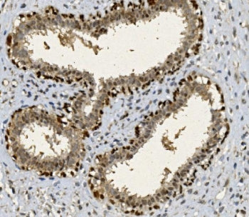 IHC staining of FFPE human breast cancer with FOXP1 antibody. HIER: boil tissue sections in pH8 EDTA