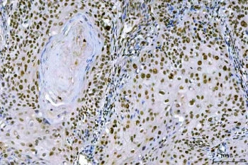 IHC staining of FFPE human laryngeal squamous cell carcinoma tissue with Ki-67 antibody. HIER: boil 