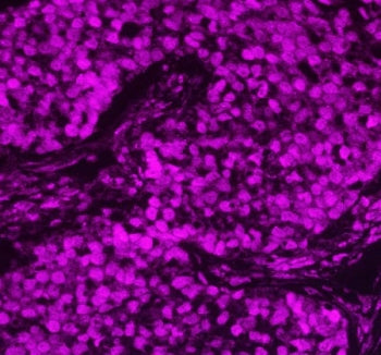 Immunofluorescent staining of FFPE human lung cancer tissue with APEX1 antibody (red). HIER: steam s