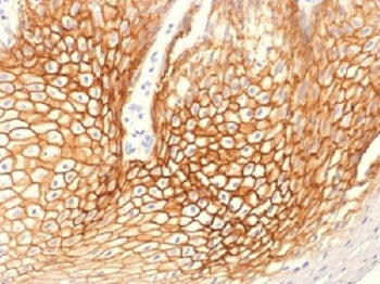 IHC testing of FFPE human cervical carcinoma with Gamma Catenin antibody (clone CTNG/1483). Required