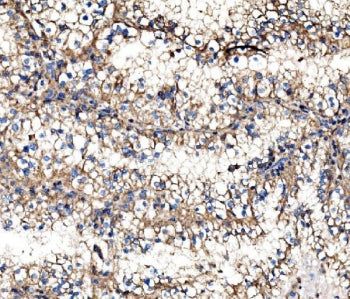 IHC staining of FFPE human renal cell carcinoma tissue with IMPDH1 antibody. HIER: boil tissue secti