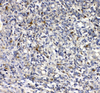 IHC staining of FFPE human glioma tissue with uPAR antibody. HIER: boil tissue sections in pH8 EDTA 
