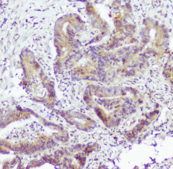 IHC staining of FFPE human colon cancer with Caspase-2 antibody at 0.5ug/ml. HIER: boil tissue secti