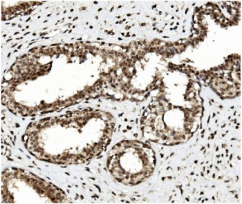 IHC staining of FFPE human breast cancer with TET1 antibody. HIER: boil tissue sections in pH8 EDTA 