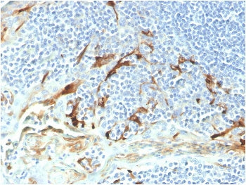 IHC staining of FFPE human endometrial carcinoma with biotinylated Mesothelin antibody (clone MSLN/2