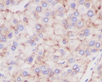 IHC staining of FFPE human liver cancer with LAMP-2A antibody. HIER: boil tissue sections in pH6, 10