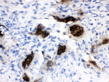IHC testing of FFPE human osteosarcoma tissue with Osteocalcin antibody. HIER: Boil the paraffin sec