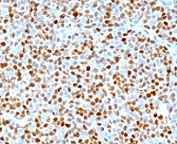 IHC: Formalin-fixed, paraffin-embedded human mantle cell lymphoma stained with CCND1 antibody.