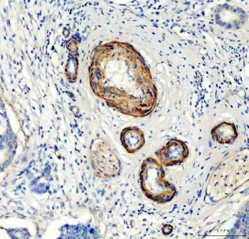 IHC testing of FFPE human breast cancer tissue with Canstatin / Collagen IV antibody at 1ug/ml. Required HIER: steam section in pH8 EDTA buffer for 20 min and allow to cool prior to staining.