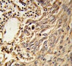 IHC testing of FFPE human lung carcinoma tissue with EIF4A2 antibody. HIER: steam section in pH6 cit