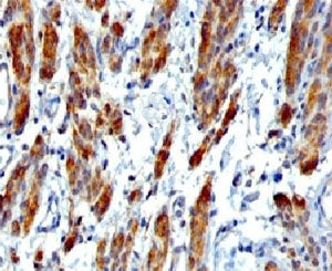 IHC testing of FFPE human Leiomyosarcoma with SMMHC antibody (clone SMM11-1). FFPE testing requires 