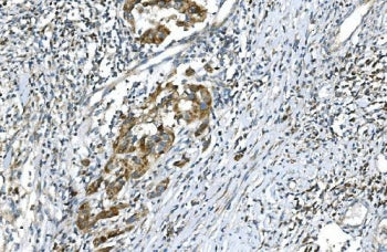 IHC staining of FFPE human bladder cancer with DR6 antibody. HIER: boil tissue sections in pH8 EDTA 