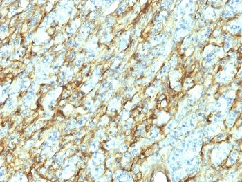 IHC: Formalin-fixed, paraffin-embedded human renal cell carcinoma stained with Fibronectin antibody 