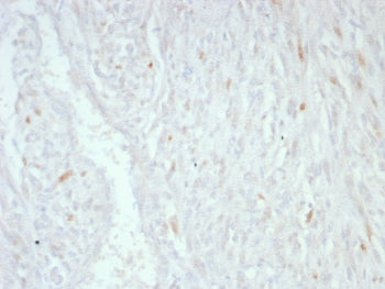 IHC staining of FFPE human liposarcoma tissue with MDM2 antibody (clone MDM2/8221). HIER: boil tissu