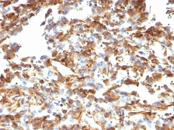 IHC: Formalin-fixed, paraffin-embedded human melanoma stained with anti-Vimentin antibody (clone VM1