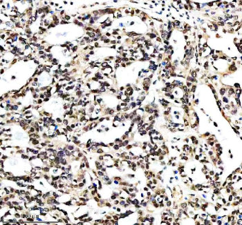 Immunohistochemical staining of RTRAF using anti-RTRAF antibody. RTRAF was detected in a paraffin-em