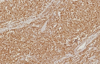 IHC staining of FFPE human colon carcinoma tissue with PMS2 antibody (clone PMS2/8374R). HIER: boil 