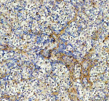 IHC staining of FFPE human testis cancer tissue with AAMP antibody, HRP-labeled secondary and DAB su