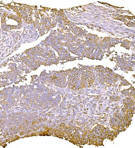 IHC staining of FFPE human ovarian serous adenocarcinoma tissue with LY6E antibody. HIER: boil tissu