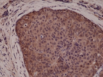 IHC testing of FFPE human breast cancer tissue with recombinant p38 antibody at 1:5000.