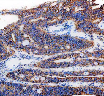 IHC staining of FFPE human colon cancer tissue with PGRMC1 antibody, HRP-secondary and DAB substrate