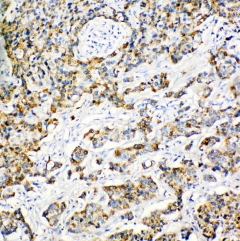 IHC staining of FFPE human breast cancer tissue with Peroxiredoxin 3 antibody. HIER: boil tissue sec