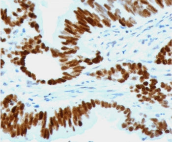 IHC staining of FFPE human colon carcinoma with recombinant p53 antibody (clone CTA53-2R). Required 