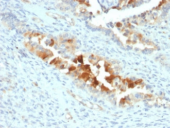 IHC staining of FFPE human endometrial carcinoma with Mesothelin antibody (clone SPM143). HIER: boil