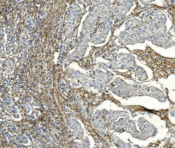 IHC staining of FFPE human breast cancer with F2R antibody. HIER: boil tissue sections in pH8 EDTA f