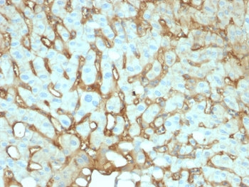 IHC testing of FFPE human hepatocellular carcinoma with human Albumin antibody (clone ALB/2141). Req